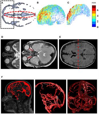 Distorted Optic Nerve Portends Neurological Complications in Infants With External Hydrocephalus